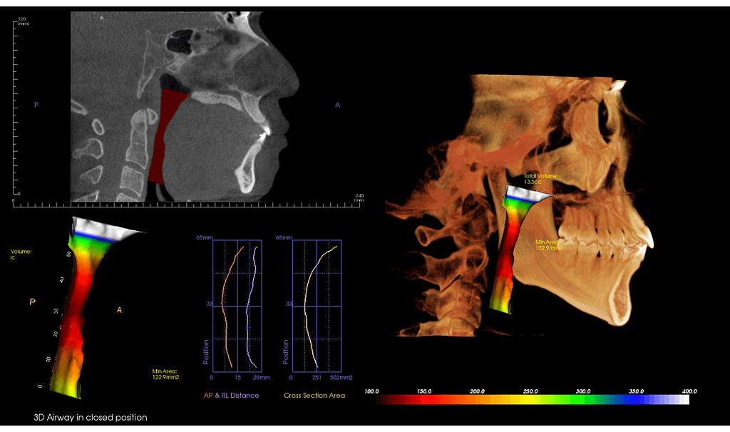 Airway Scan