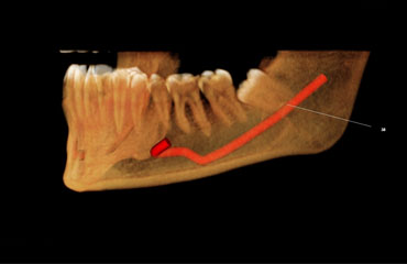 Mandible / Maxilla