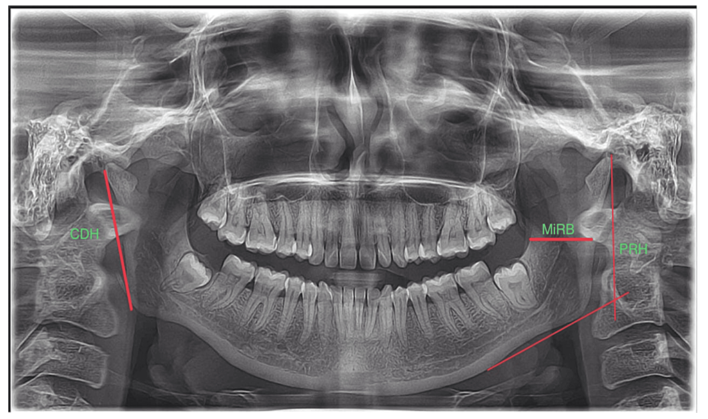Mandible / Maxilla
